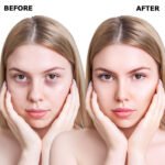 dark-circle-reduction-treatment